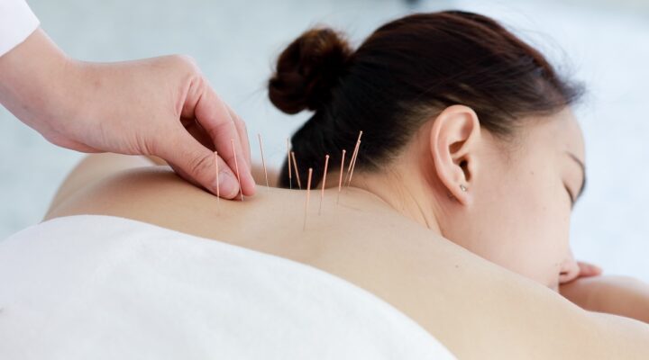 acupuncture-rhema-gold-physiotherapy-calgary-ab