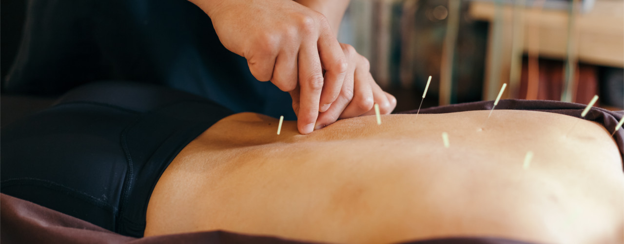 Acupuncture-rhema-gold-physiotherapy-Calgary-AB