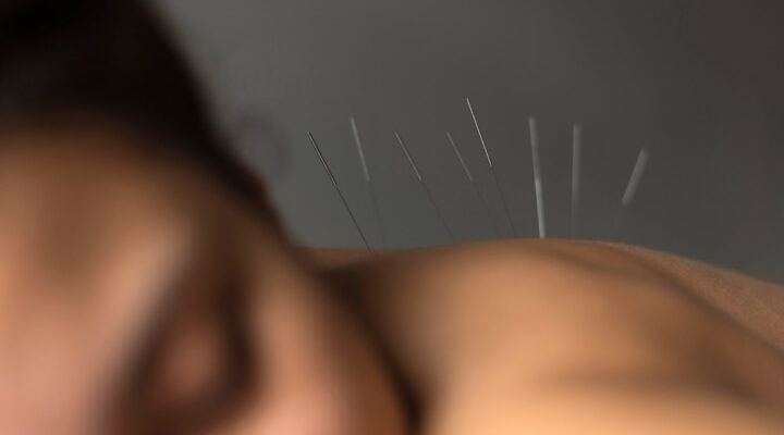 best-acupuncture-in-Calgary-rhema-gold-physiotherapy-calgary-ab