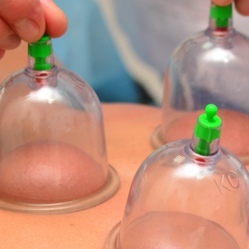 cupping-rhema-gold-physiotherapy-Calgary-AB