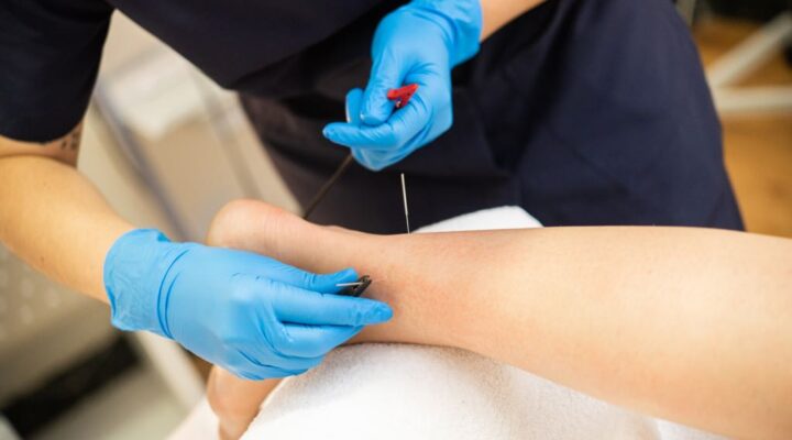 embracing-dry-needling-rhema-gold-physiotherapy-calgary-ab