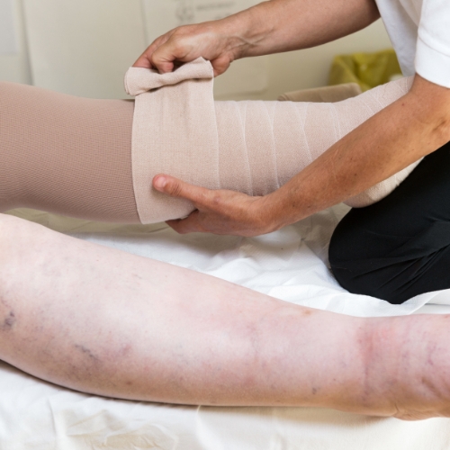 lymphedema-rhema-gold-physiotherapy-Calgary-AB